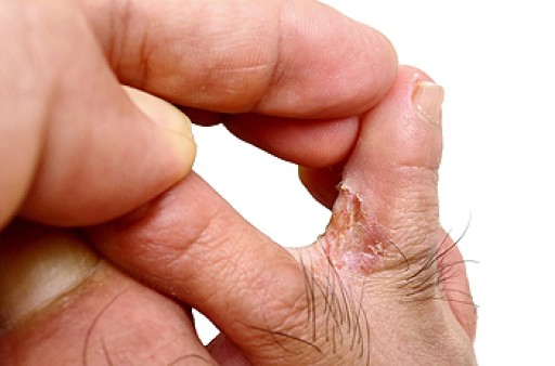 Causes and Symptoms of Athlete's Foot - Blog